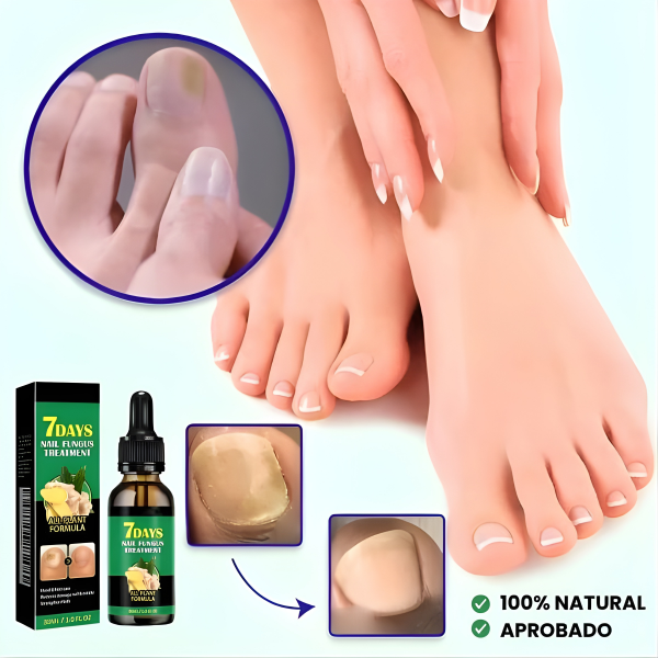 TRATAMIENTO ANTI HONGOS 7 DÍAS 100% NATURAL