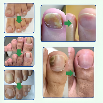 TRATAMIENTO ANTI HONGOS 7 DÍAS 100% NATURAL